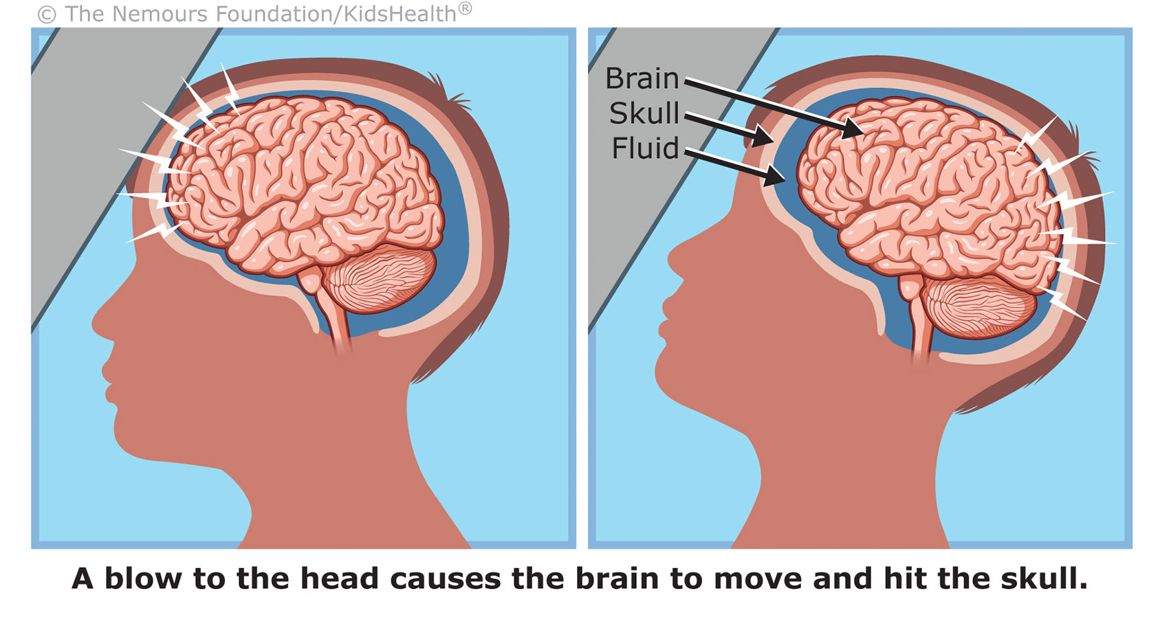 Medical-Educational-illustration-Medical_Concussion Discharge-Bill-Graham