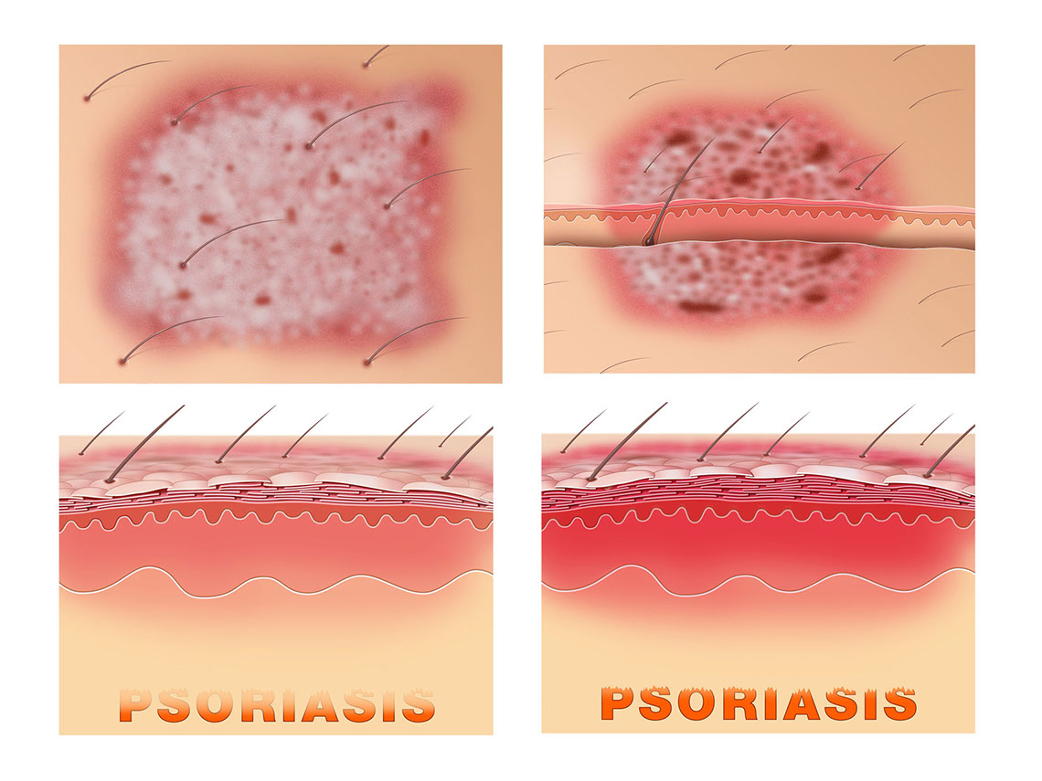 Medical-Educational-illustration-Medical_Psoriasis-Bill-Graham